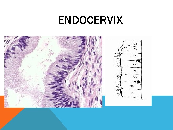 ENDOCERVIX ENDOCERVIX