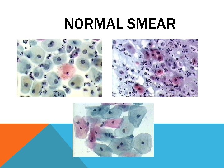 NORMAL SMEAR NORMAL SMEAR