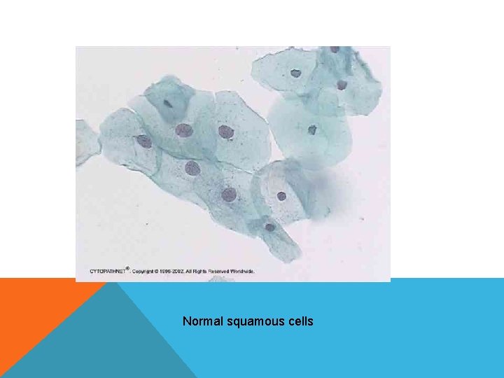 Normal squamous cells Normal squamous cells