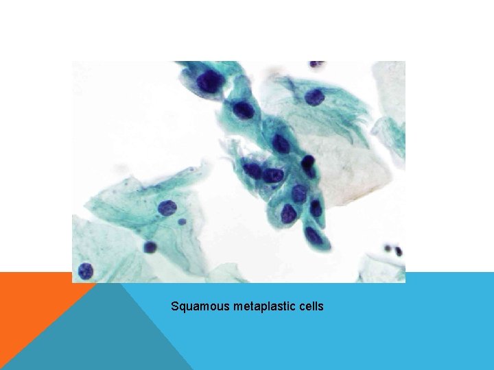 Squamous metaplastic cells Squamous metaplastic cells