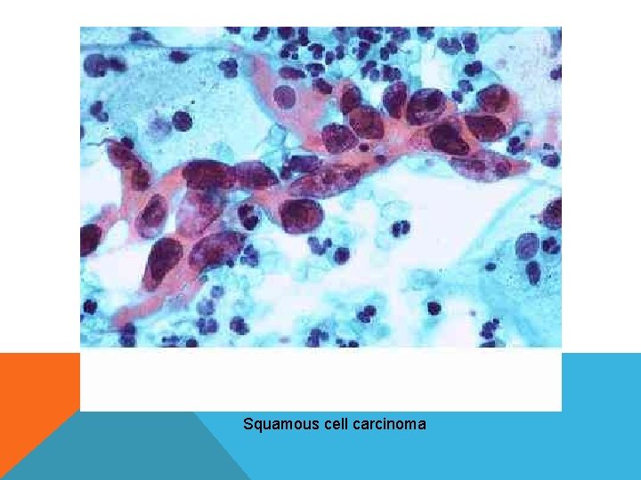 Squamous cell carcinoma Squamous cell carcinoma