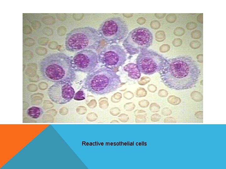 Reactive mesothelial cells Reactive mesothelial cells
