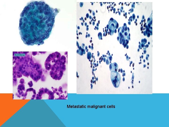 Metastatic malignant cells Metastatic malignant cells