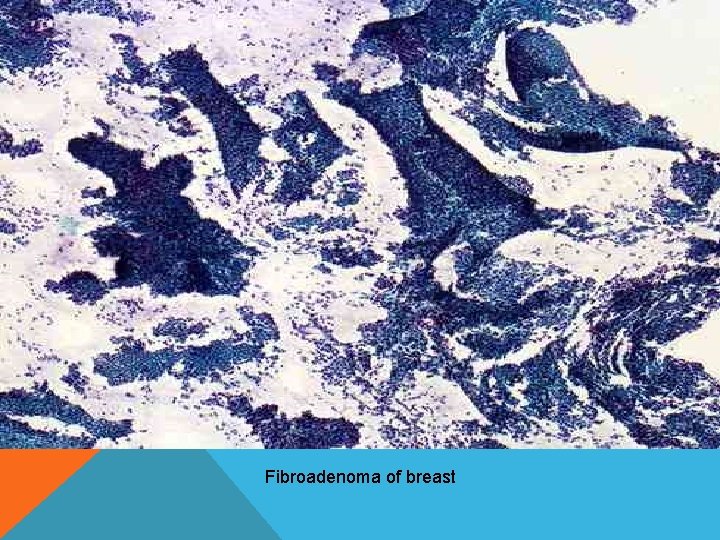 Fibroadenoma of breast Fibroadenoma of breast