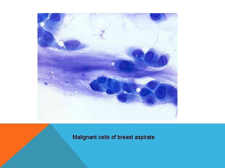 Malignant cells of breast aspirate Malignant cells of breast aspirate