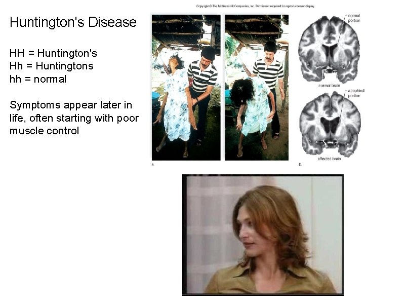 Huntington's Disease HH = Huntington's Hh = Huntingtons hh = normal Symptoms appear later