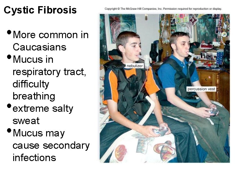 Cystic Fibrosis • More common in Caucasians • Mucus in • • respiratory tract,