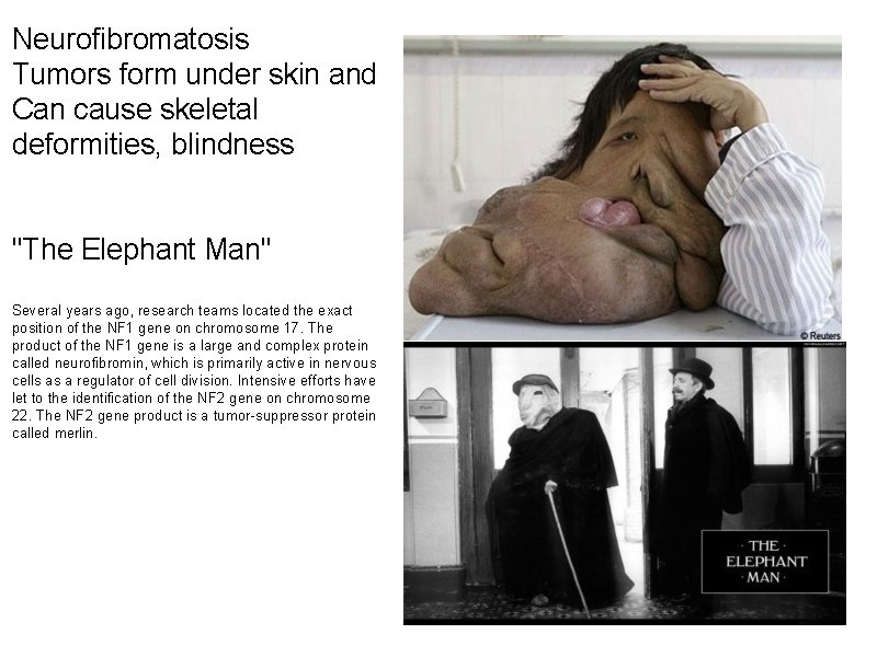 Neurofibromatosis Tumors form under skin and Can cause skeletal deformities, blindness "The Elephant Man"