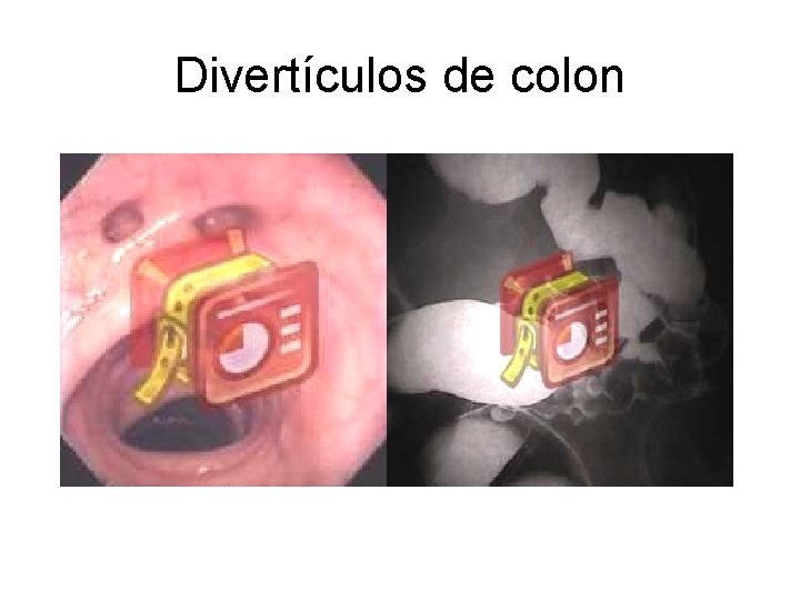 Divertículos de colon 