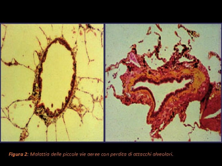 Figura 2: Malattia delle piccole vie aeree con perdita di attacchi alveolari. 