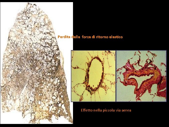 Perdita della forza di ritorno elastico Effetto nella piccola via aerea 