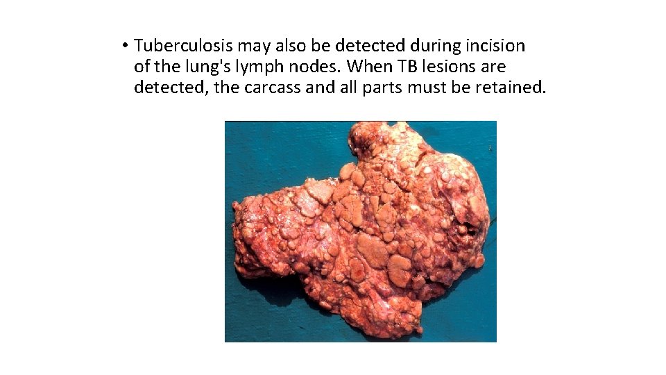  • Tuberculosis may also be detected during incision of the lung's lymph nodes.