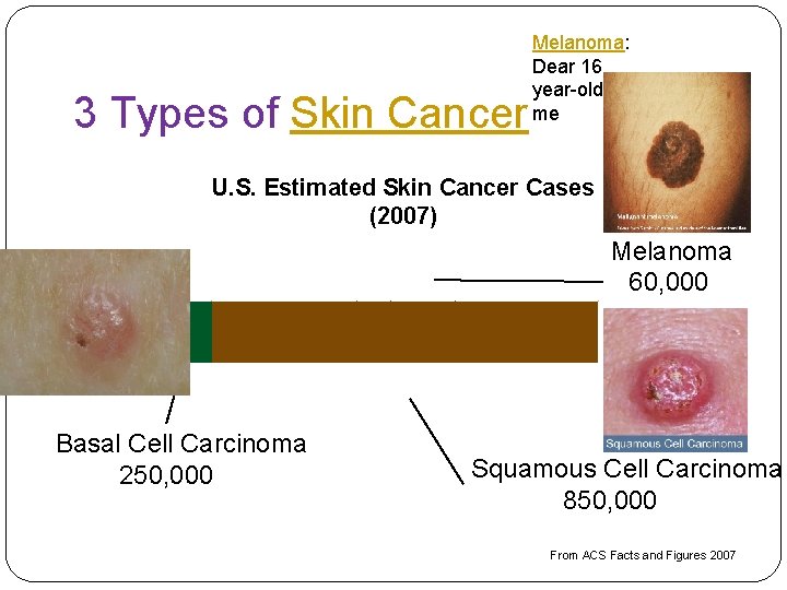 3 Types of Skin Cancer Melanoma: Dear 16 year-old me U. S. Estimated Skin