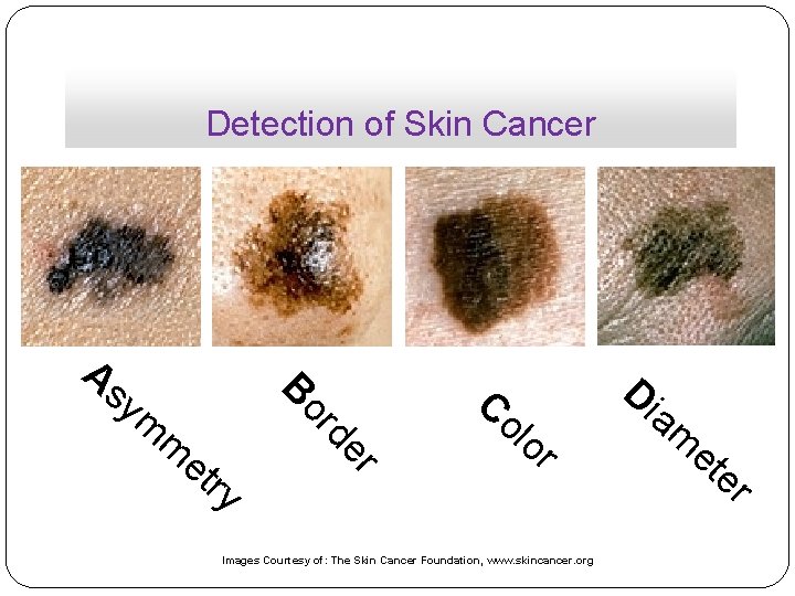 Detection of Skin Cancer As B ym r ry de or m et Co