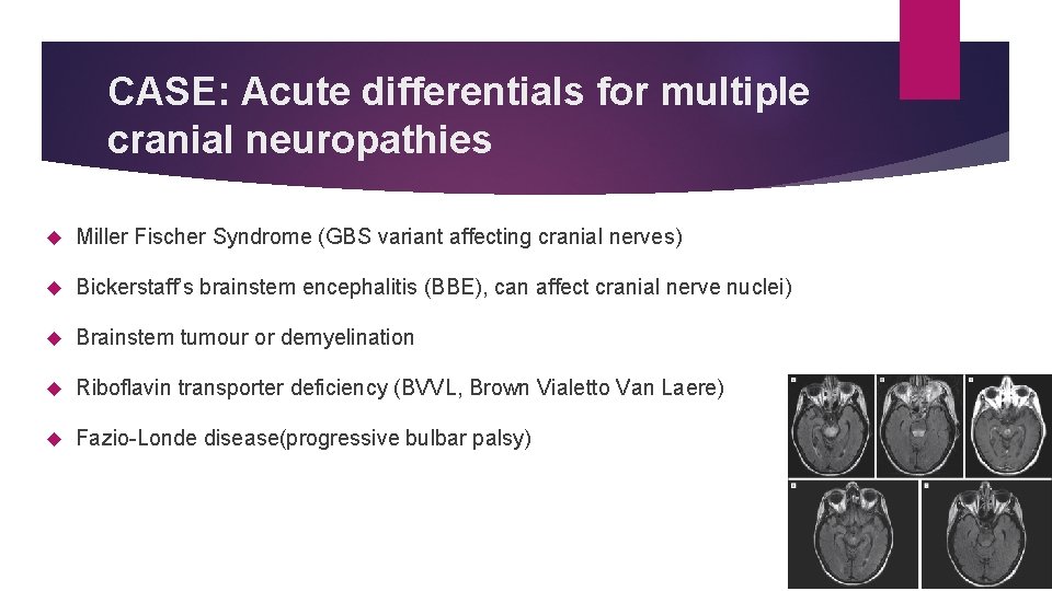 CASE: Acute differentials for multiple cranial neuropathies Miller Fischer Syndrome (GBS variant affecting cranial