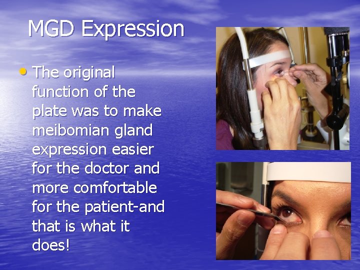 MGD Expression • The original function of the plate was to make meibomian gland