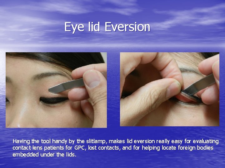 Eye lid Eversion Having the tool handy by the slitlamp, makes lid eversion really