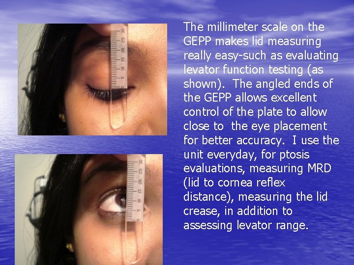 The millimeter scale on the GEPP makes lid measuring really easy-such as evaluating levator