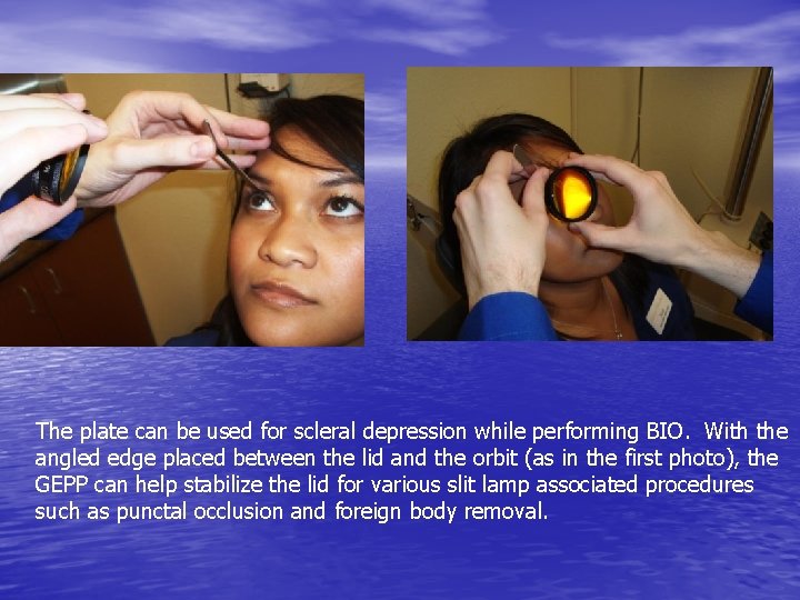 The plate can be used for scleral depression while performing BIO. With the angled