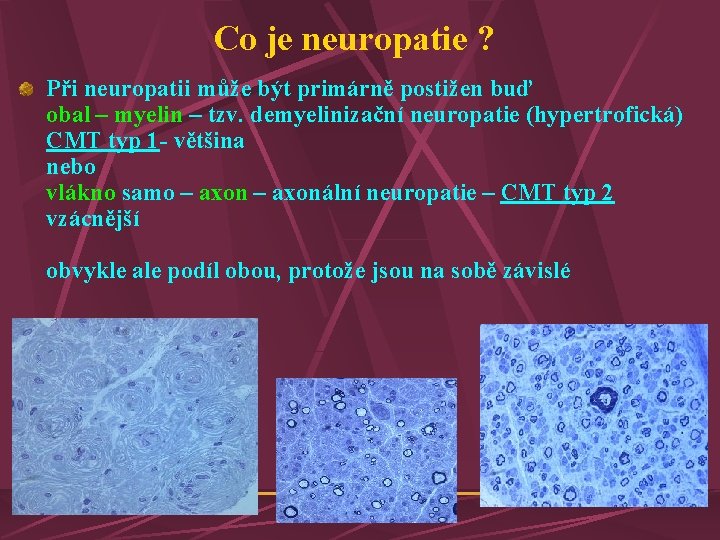 Co je neuropatie ? Při neuropatii může být primárně postižen buď obal – myelin