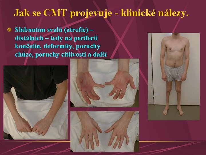 Jak se CMT projevuje - klinické nálezy. Slábnutím svalů (atrofie) – distálních – tedy Jak se CMT projevuje - klinické nálezy. Slábnutím svalů (atrofie) – distálních – tedy