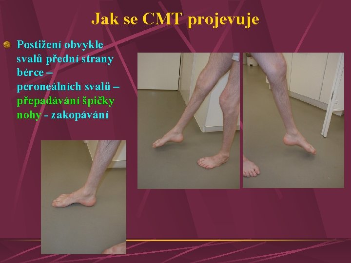 Jak se CMT projevuje Postižení obvykle svalů přední strany bérce – peroneálních svalů –