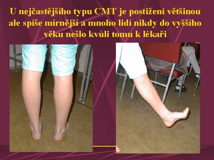 U nejčastějšího typu CMT je postižení většinou ale spíše mírnější a mnoho lidí nikdy