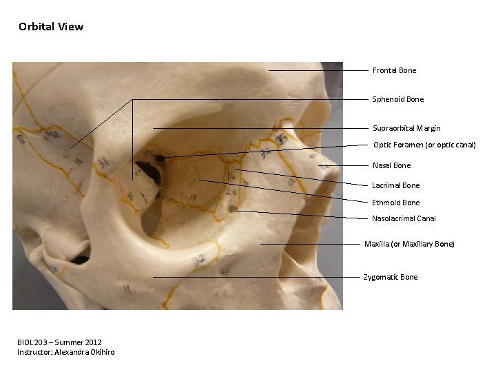 Orbital View Frontal Bone Sphenoid Bone Supraorbital Margin Optic Foramen (or optic canal) Nasal