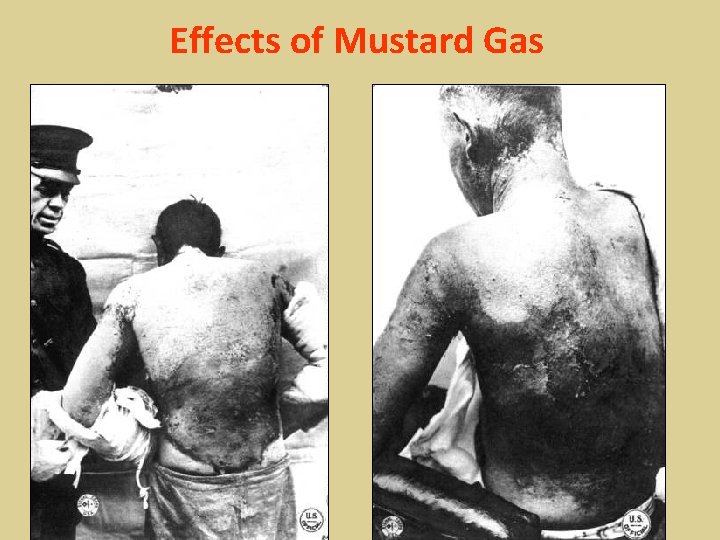 Effects of Mustard Gas 