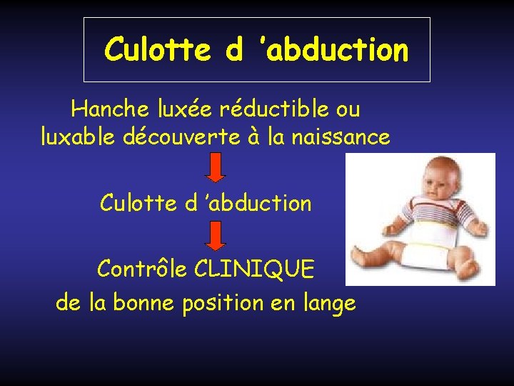 Culotte d ’abduction Hanche luxée réductible ou luxable découverte à la naissance Culotte d Culotte d ’abduction Hanche luxée réductible ou luxable découverte à la naissance Culotte d