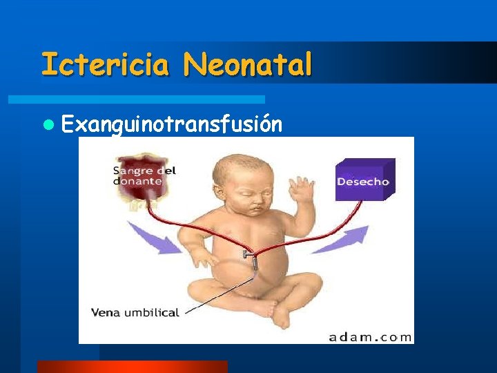 Ictericia Neonatal l Exanguinotransfusión 