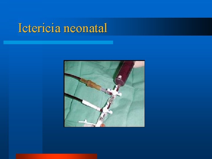 Ictericia neonatal 