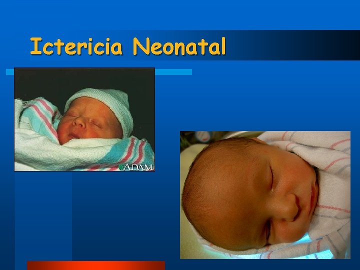 Ictericia Neonatal 