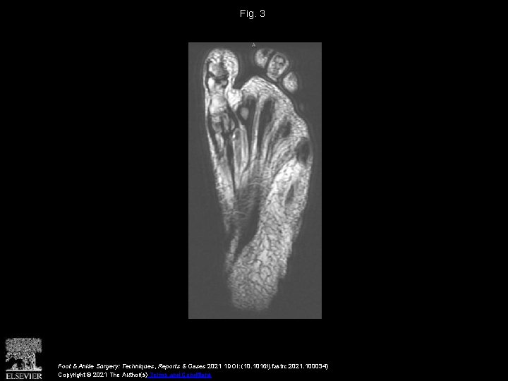 Fig. 3 Foot & Ankle Surgery: Techniques, Reports & Cases 2021 1 DOI: (10.