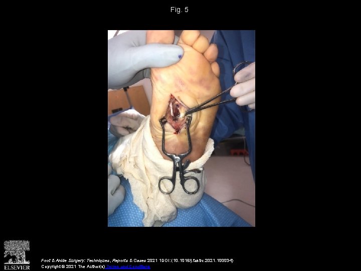 Fig. 5 Foot & Ankle Surgery: Techniques, Reports & Cases 2021 1 DOI: (10.