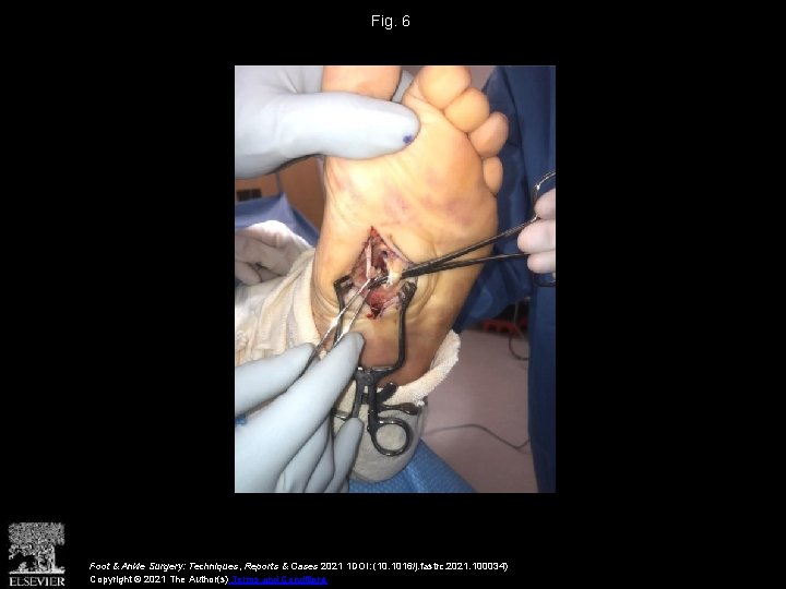 Fig. 6 Foot & Ankle Surgery: Techniques, Reports & Cases 2021 1 DOI: (10.