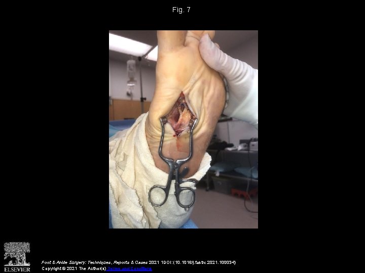 Fig. 7 Foot & Ankle Surgery: Techniques, Reports & Cases 2021 1 DOI: (10.