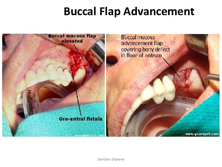 Buccal Flap Advancement Dentistry Explorer 