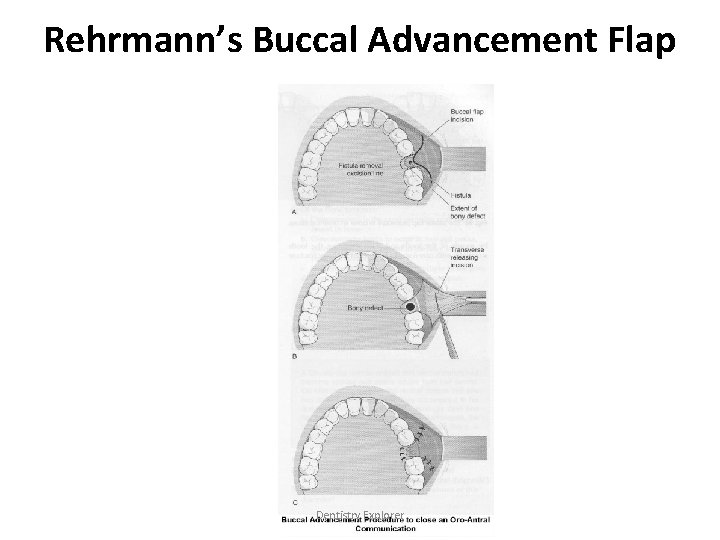 Rehrmann’s Buccal Advancement Flap Dentistry Explorer 