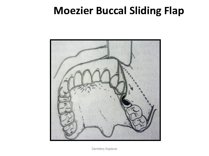 Moezier Buccal Sliding Flap Dentistry Explorer 