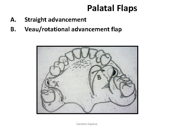 Palatal Flaps A. B. Straight advancement Veau/rotational advancement flap Dentistry Explorer 