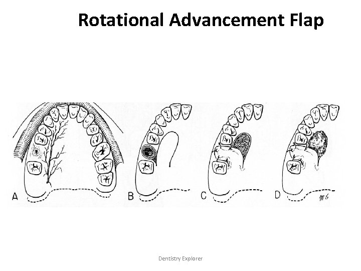 Rotational Advancement Flap Dentistry Explorer 