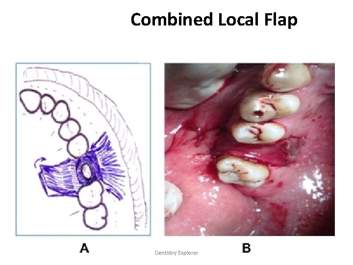 Combined Local Flap Dentistry Explorer 