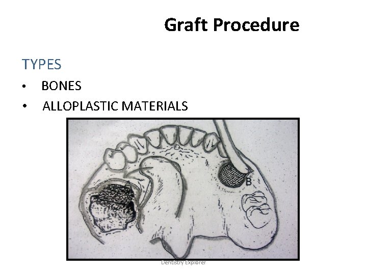 Graft Procedure TYPES BONES • ALLOPLASTIC MATERIALS • Dentistry Explorer 