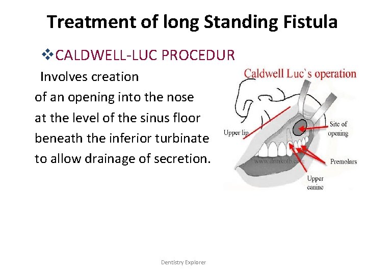 Treatment of long Standing Fistula v. CALDWELL-LUC PROCEDUR Involves creation of an opening into