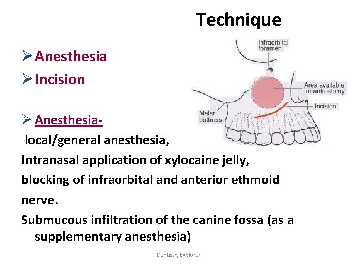 Technique Ø Anesthesia Ø Incision Ø Anesthesialocal/general anesthesia, Intranasal application of xylocaine jelly, blocking