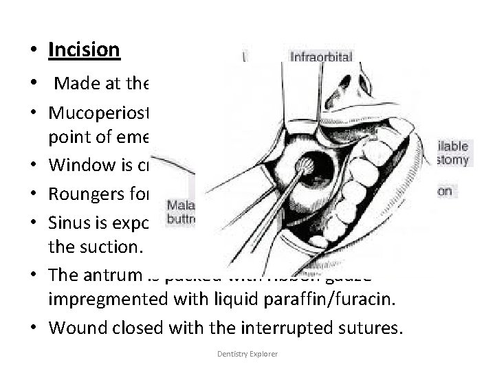  • Incision • Made at the canine mucobuccal fold. • Mucoperiostal flap is