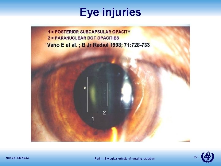 Eye injuries Nuclear Medicine Part 1. Biological effects of ionizing radiation 27 