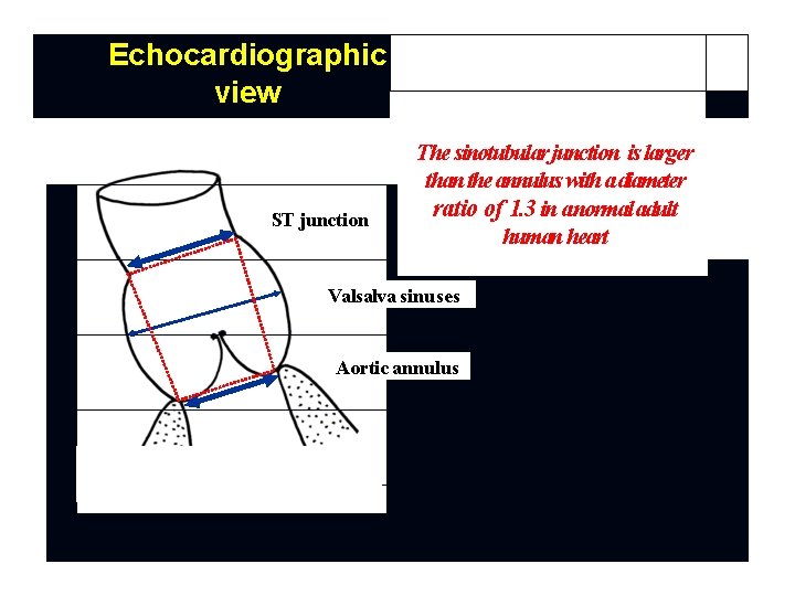 Echocardiographic view ST junction The sinotubular junction is larger than the annulus with a