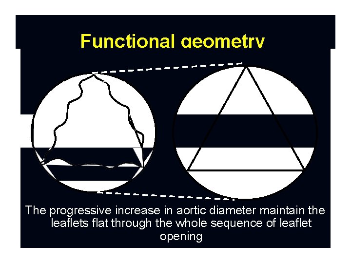 Functional geometry The progressive increase in aortic diameter maintain the leaflets flat through the